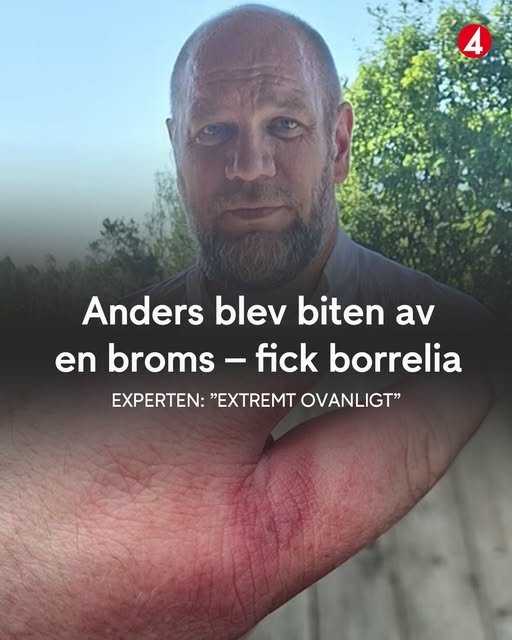 Anders blev biten av en broms – fick borrelia